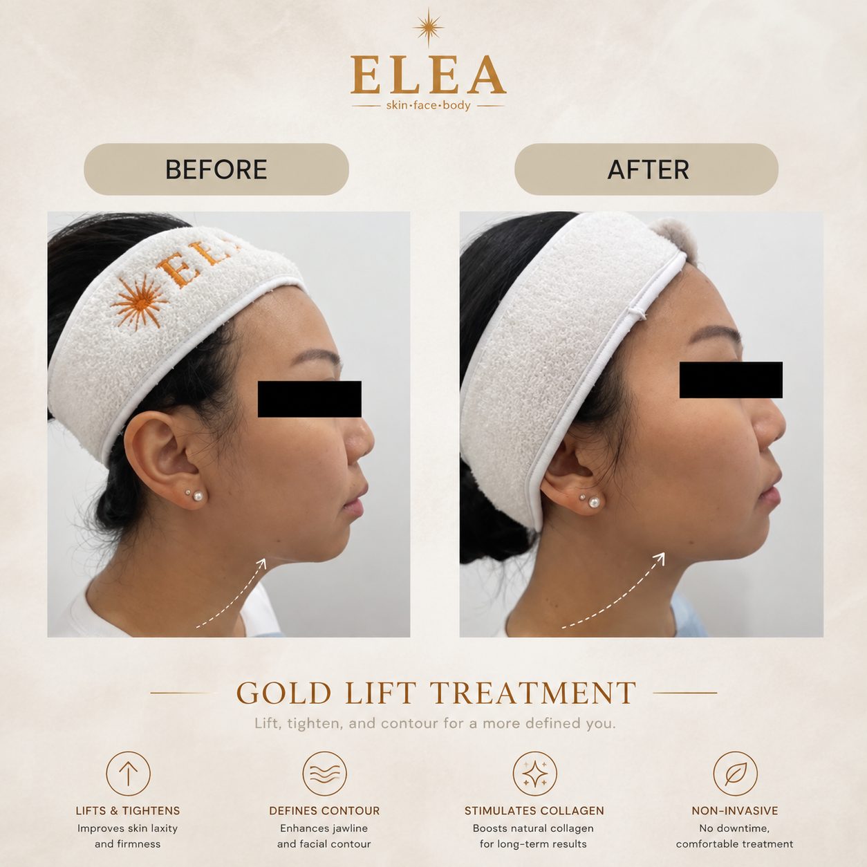 Jawline definition before and after non-surgical lifting at Elea Clinic Bali