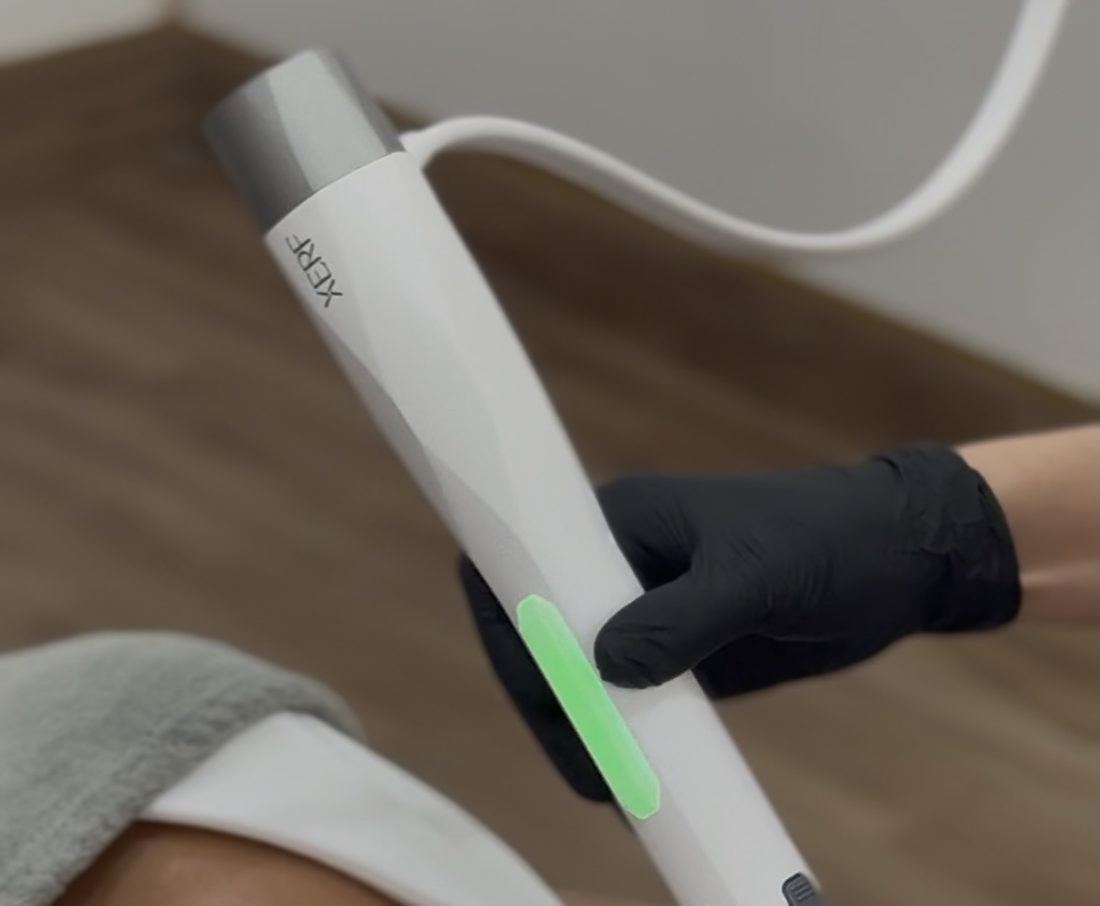 XERF handpiece treating the upper face at Elea Clinic Bali