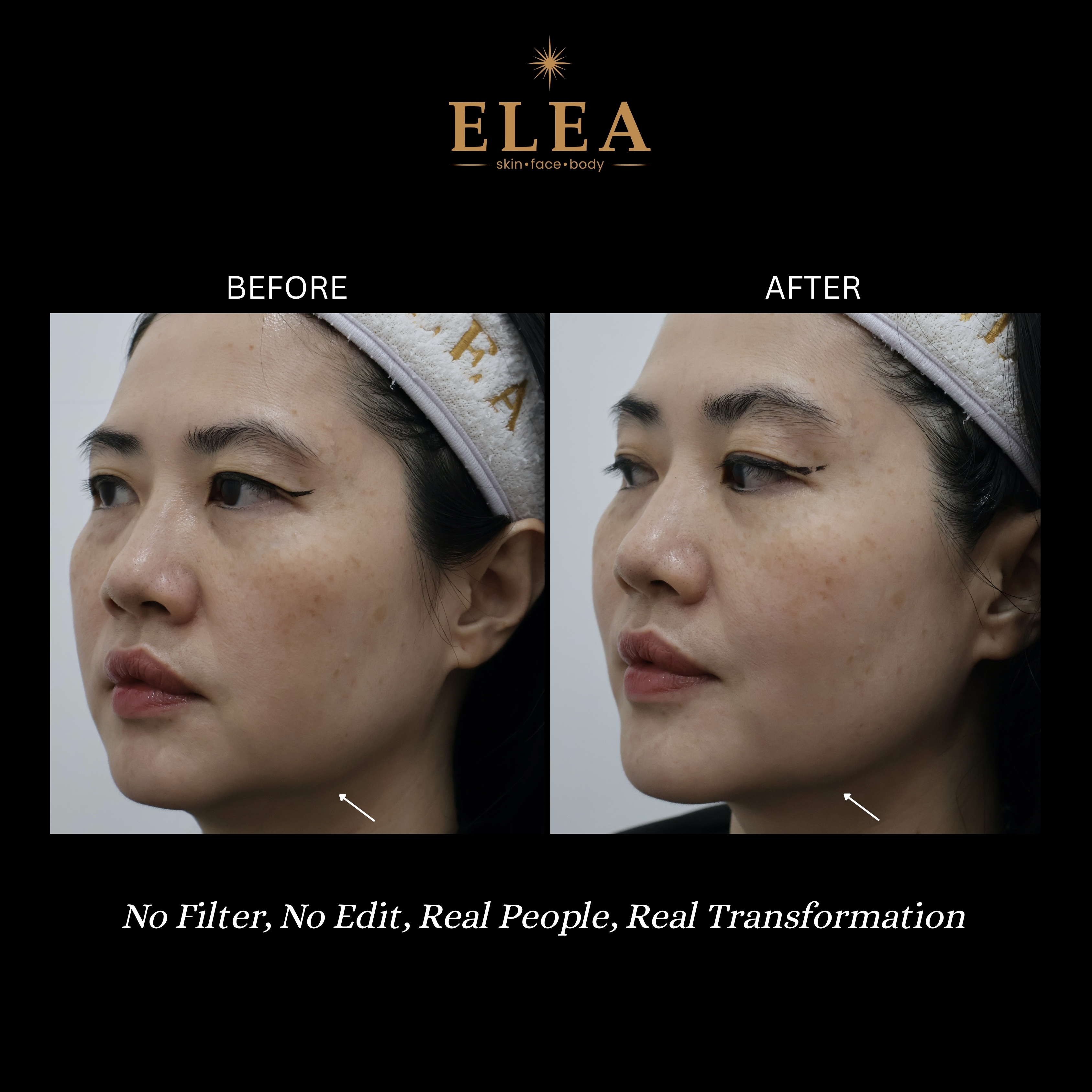 XERF Before & After — Jawline Lift — Elea Clinic Bali