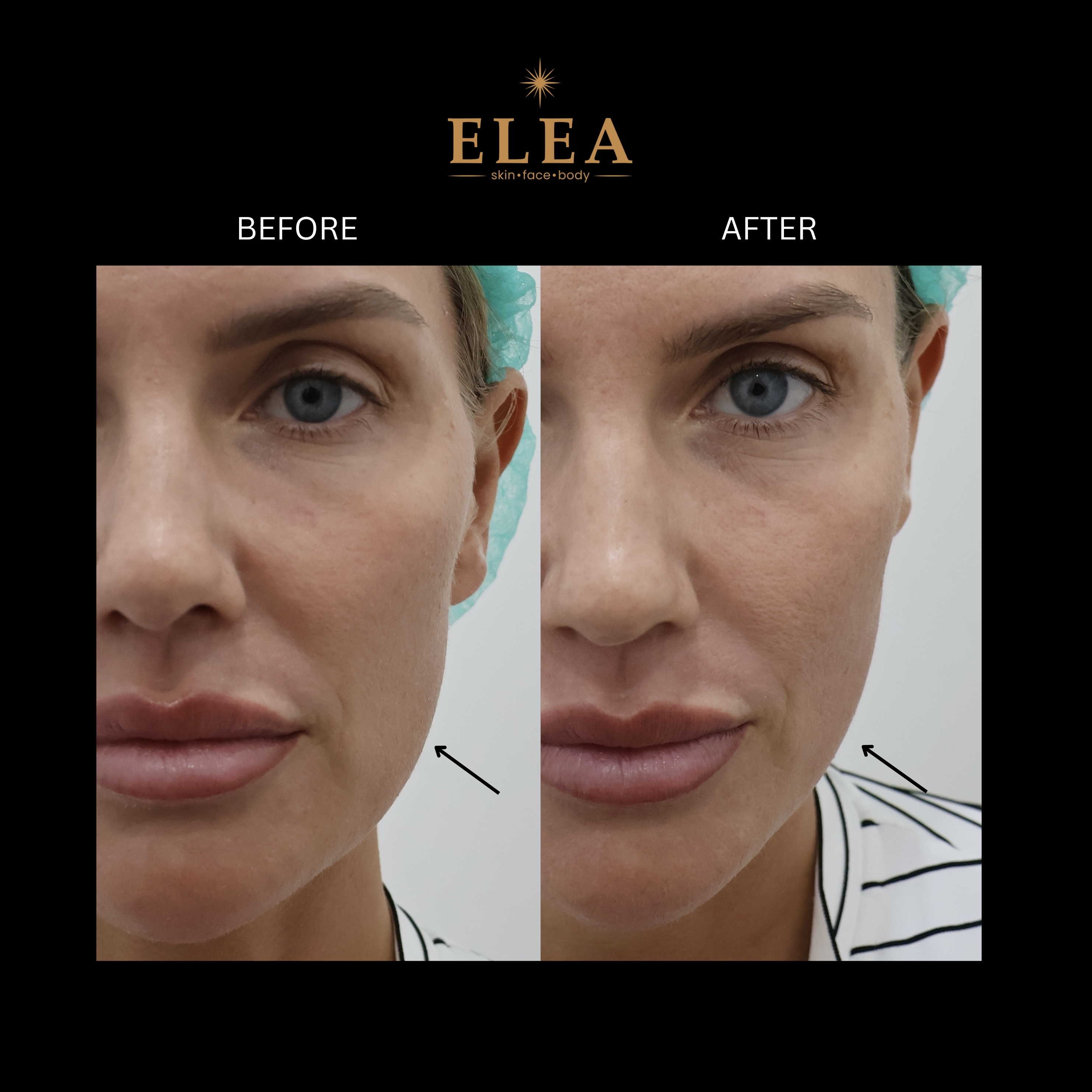 XERF Before & After — Facial Tightening — Elea Clinic Bali
